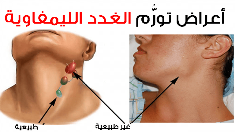 ما فائدة الغدد اللمفاوية وكيف يمكن علاج تورمها بريم نيوز